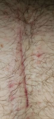 wound at day 35