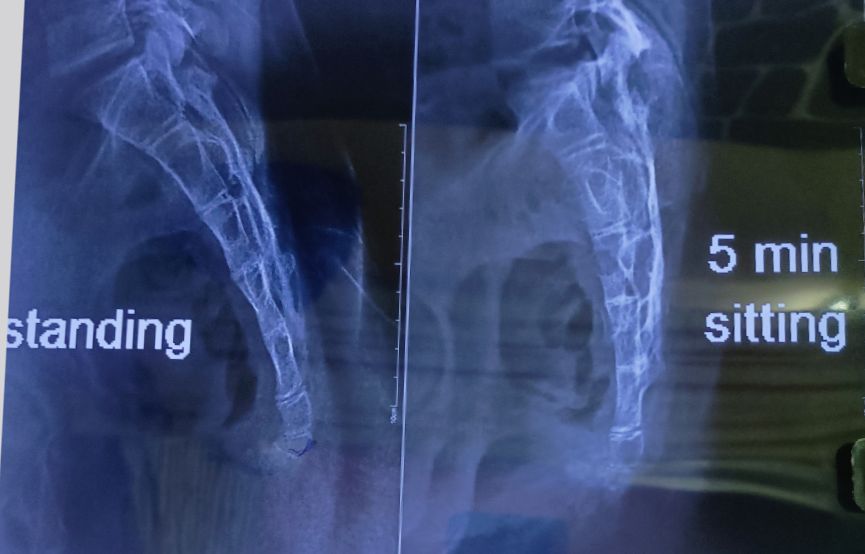 sit stand x-ray