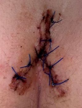 scar at 11 days