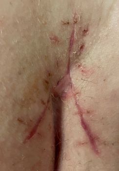 scar at 17 days