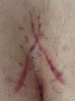 scar at 28 days