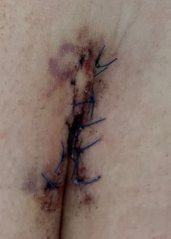 scar at 5 days