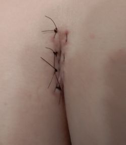 stitches
