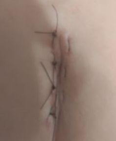 stitches