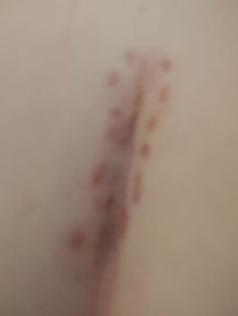 stitches