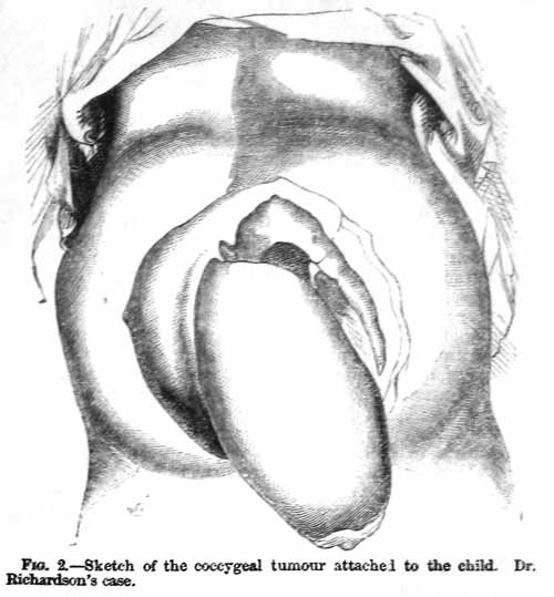 Fig 2. Sketch of the coccygeal tumour attached to the child