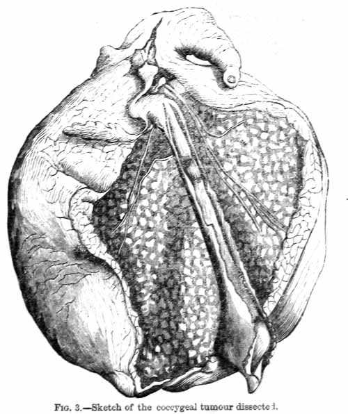 Fig 3. Sketch of the coccygeal tumour dissected