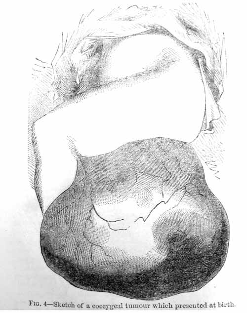 Fig 2. Sketch of a coccygeal tumour which presented at birth