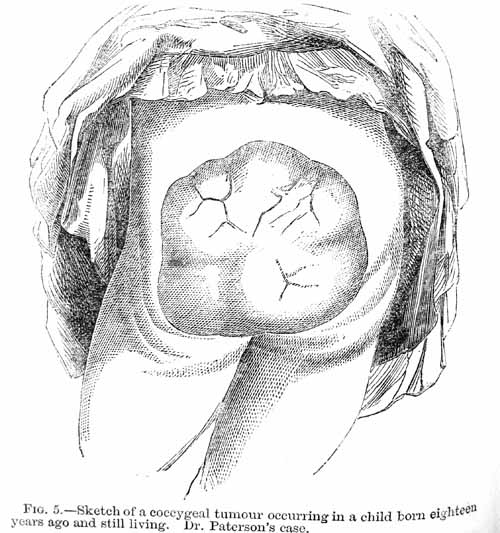Fig 5. Sketch of a coccygeal tumour occurring in a child born eighteen years ago and still living. Dr. Paterson's case.