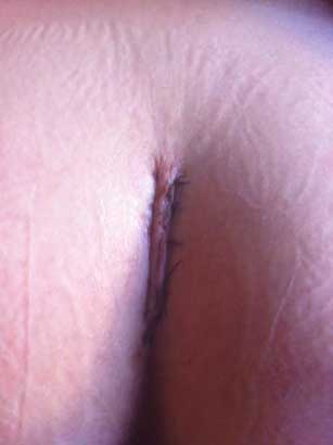 coccygectomy scar 1